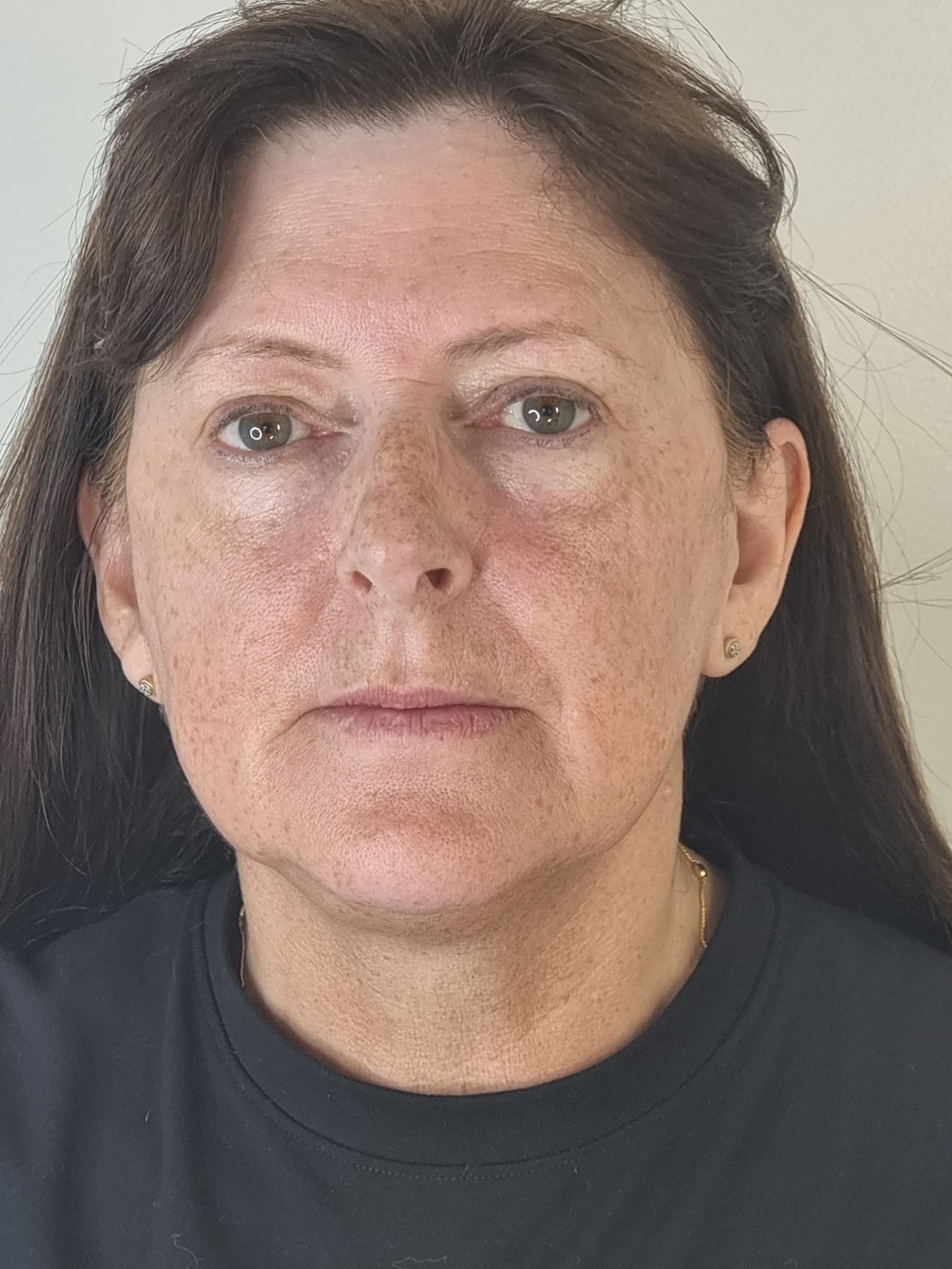 Before Collagen Wave — front view