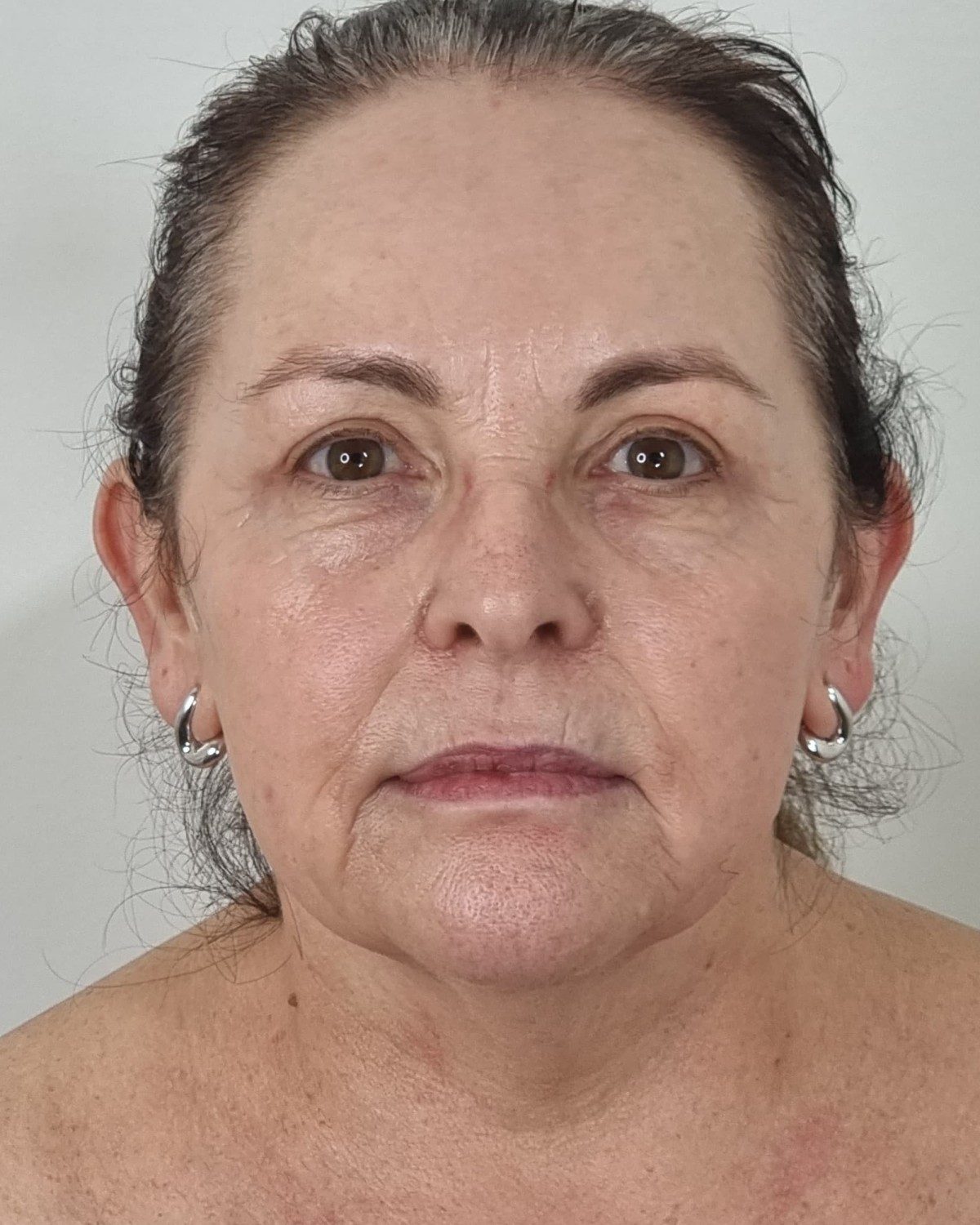 Before Collagen Wave — front view