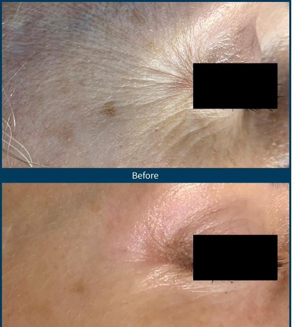 SkinPen — crow's feet 5 treatments