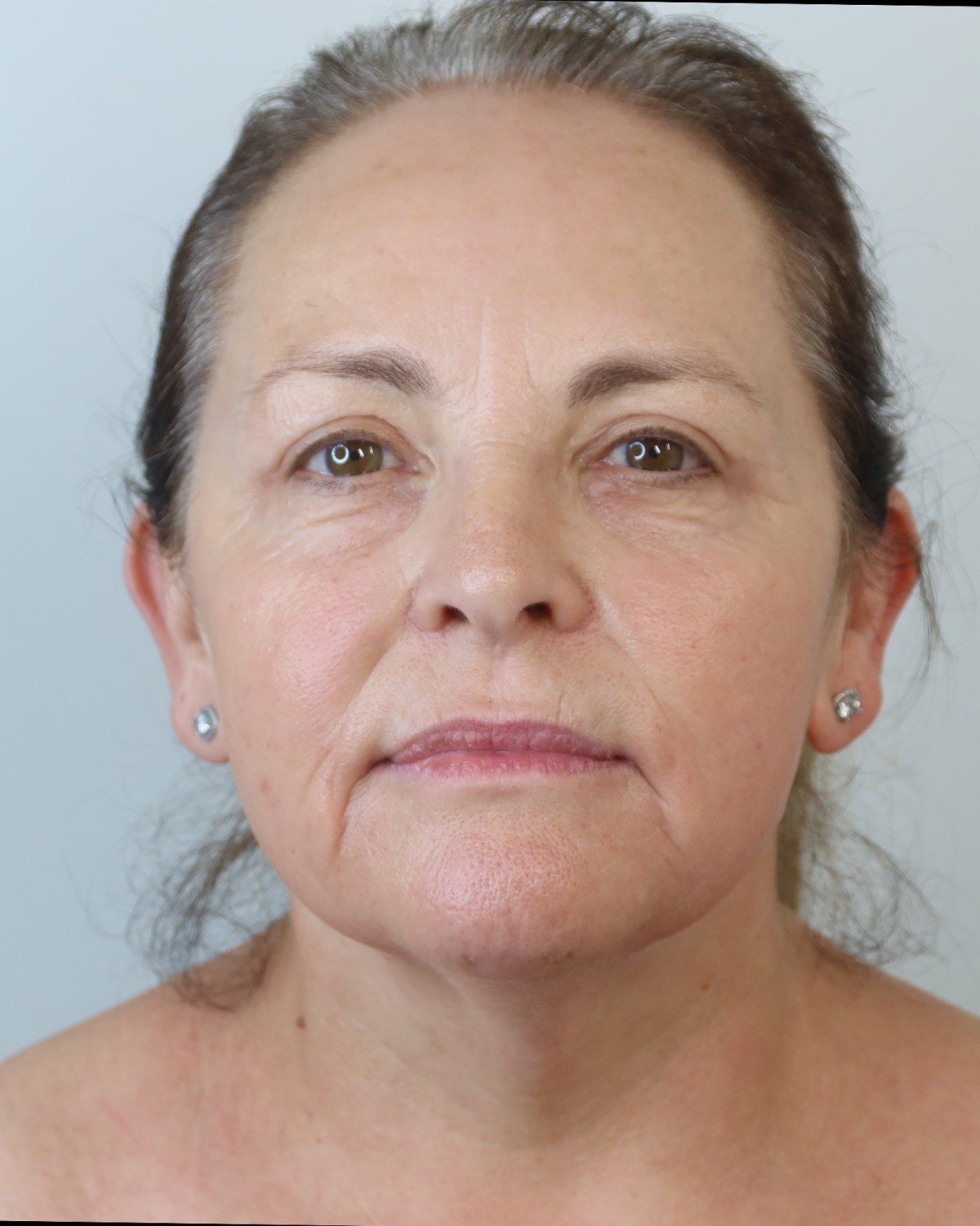 After a Collagen Wave course of four — front view