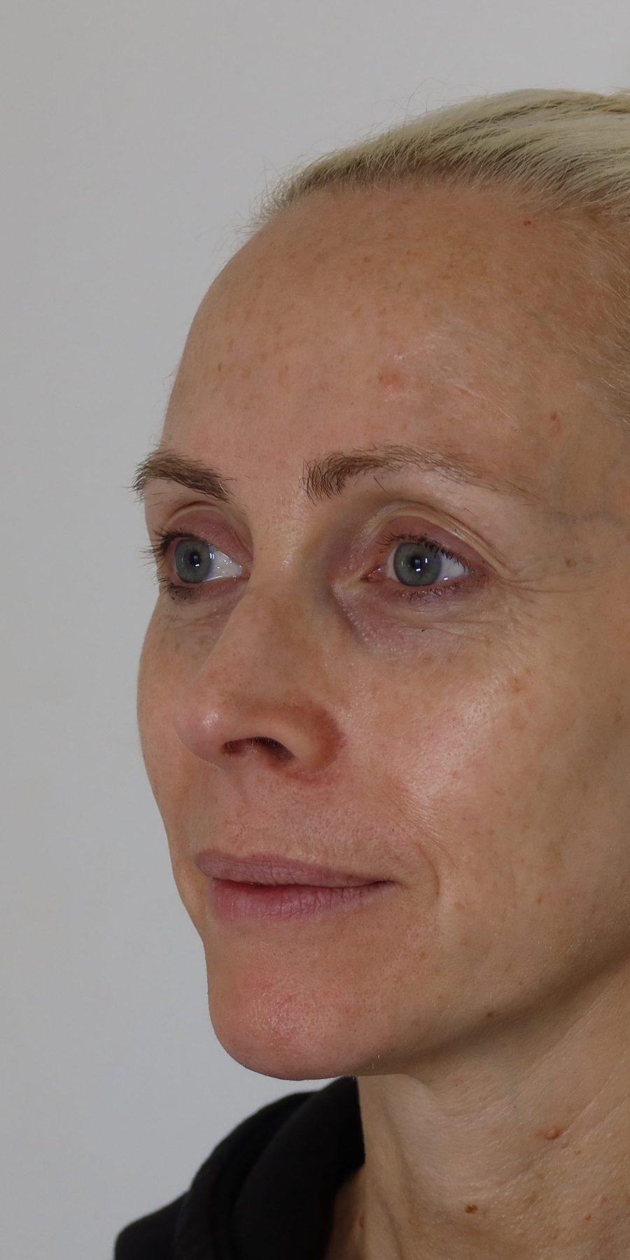 Sophie — after four weekly Collagen Wave sessions