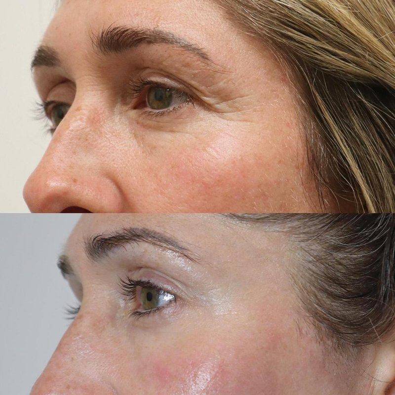 Periorbital — after plasma treatment