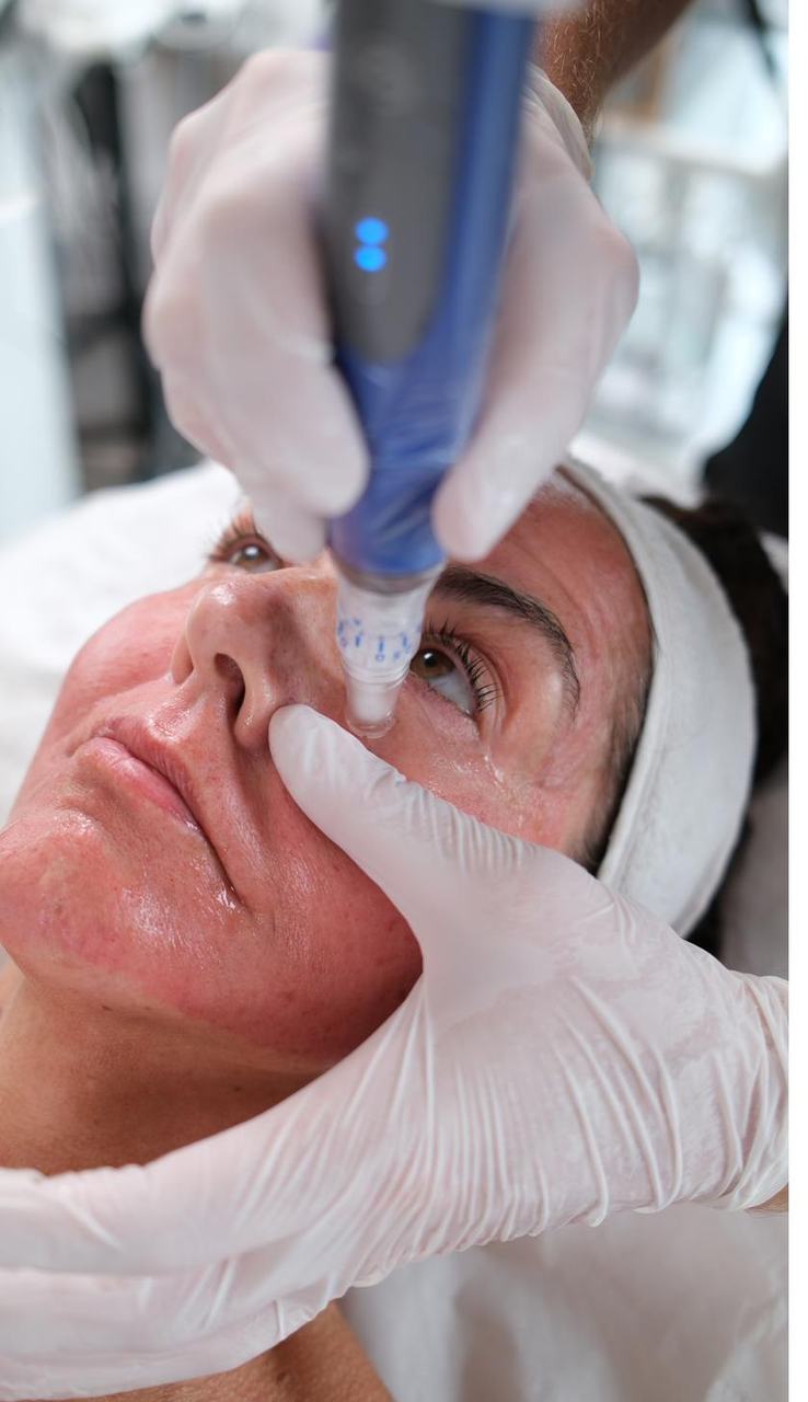 SkinPen microneedling at MNP Clinic, Hornchurch