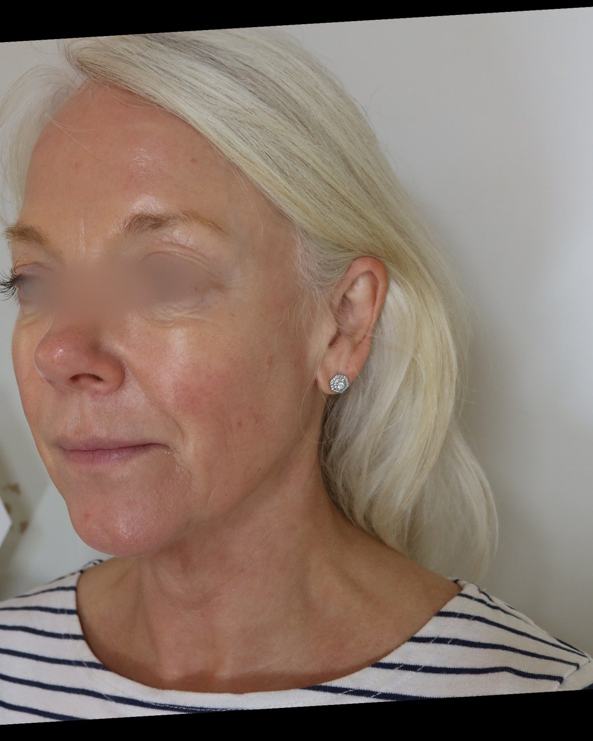 After a Collagen Wave course of four — three-quarter view