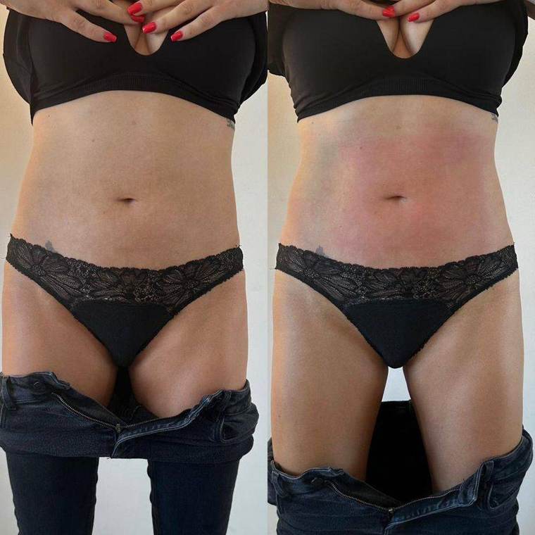 Before and after