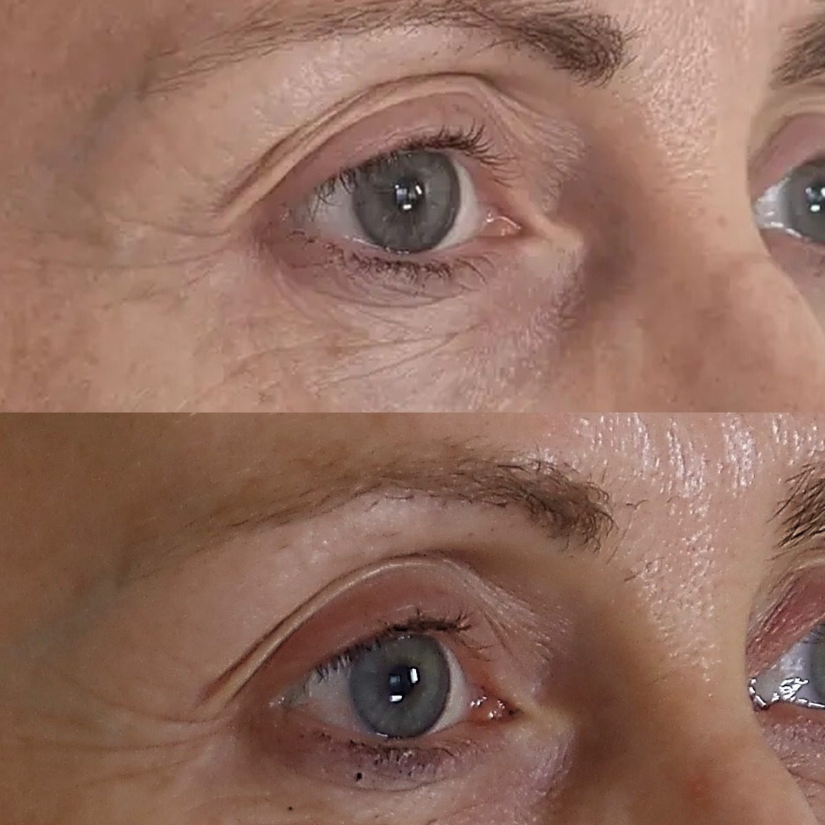 Sophie — around the eyes, before above and four weeks below