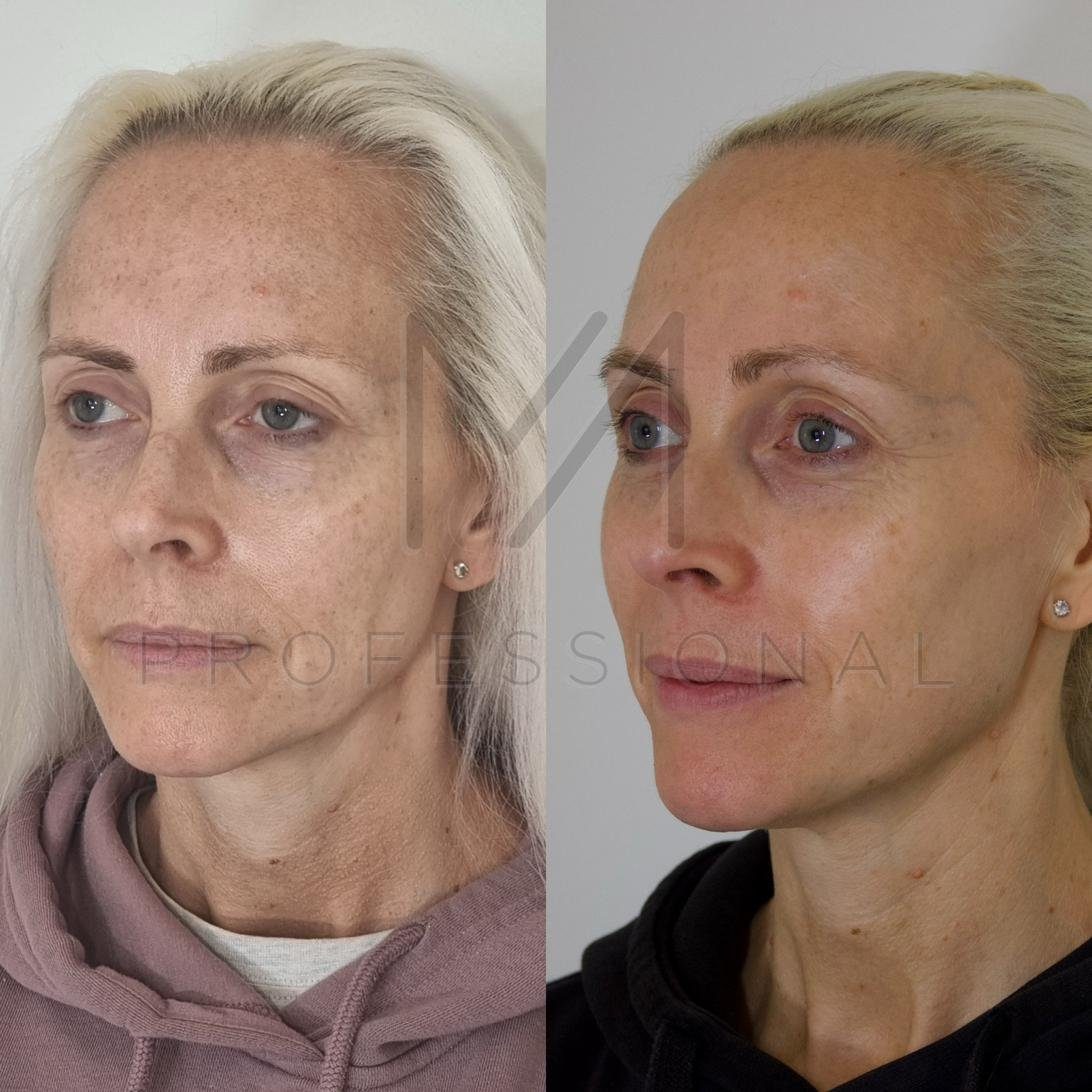 Before & After