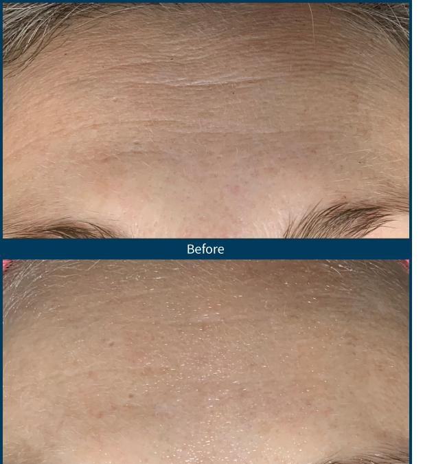 SkinPen — forehead 5 treatments