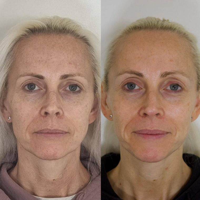 Before and after