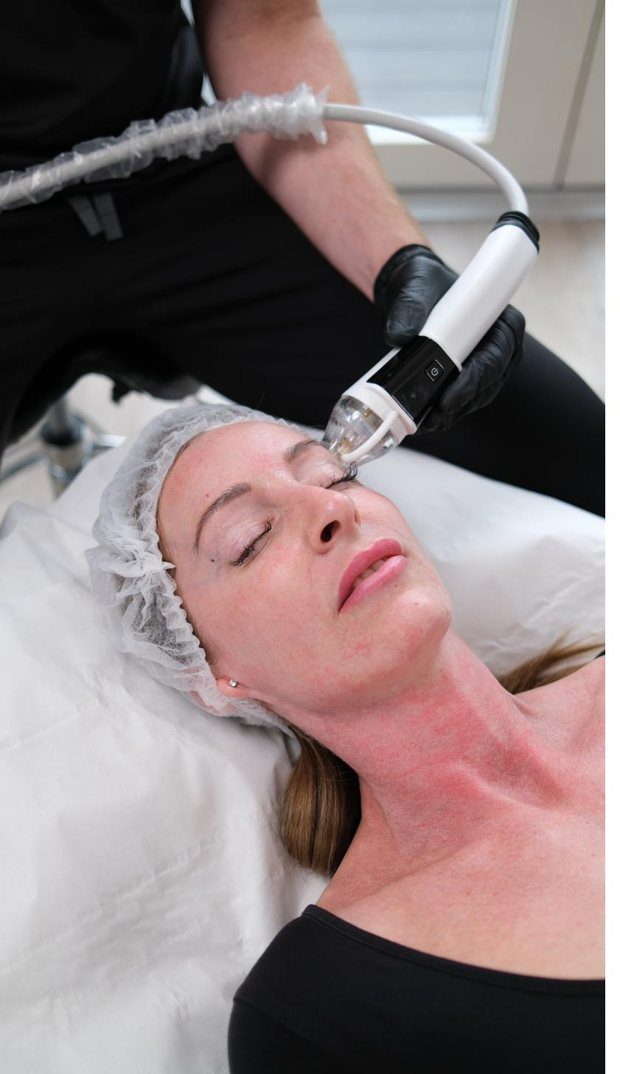 PureDerma RF microneedling treatment in progress