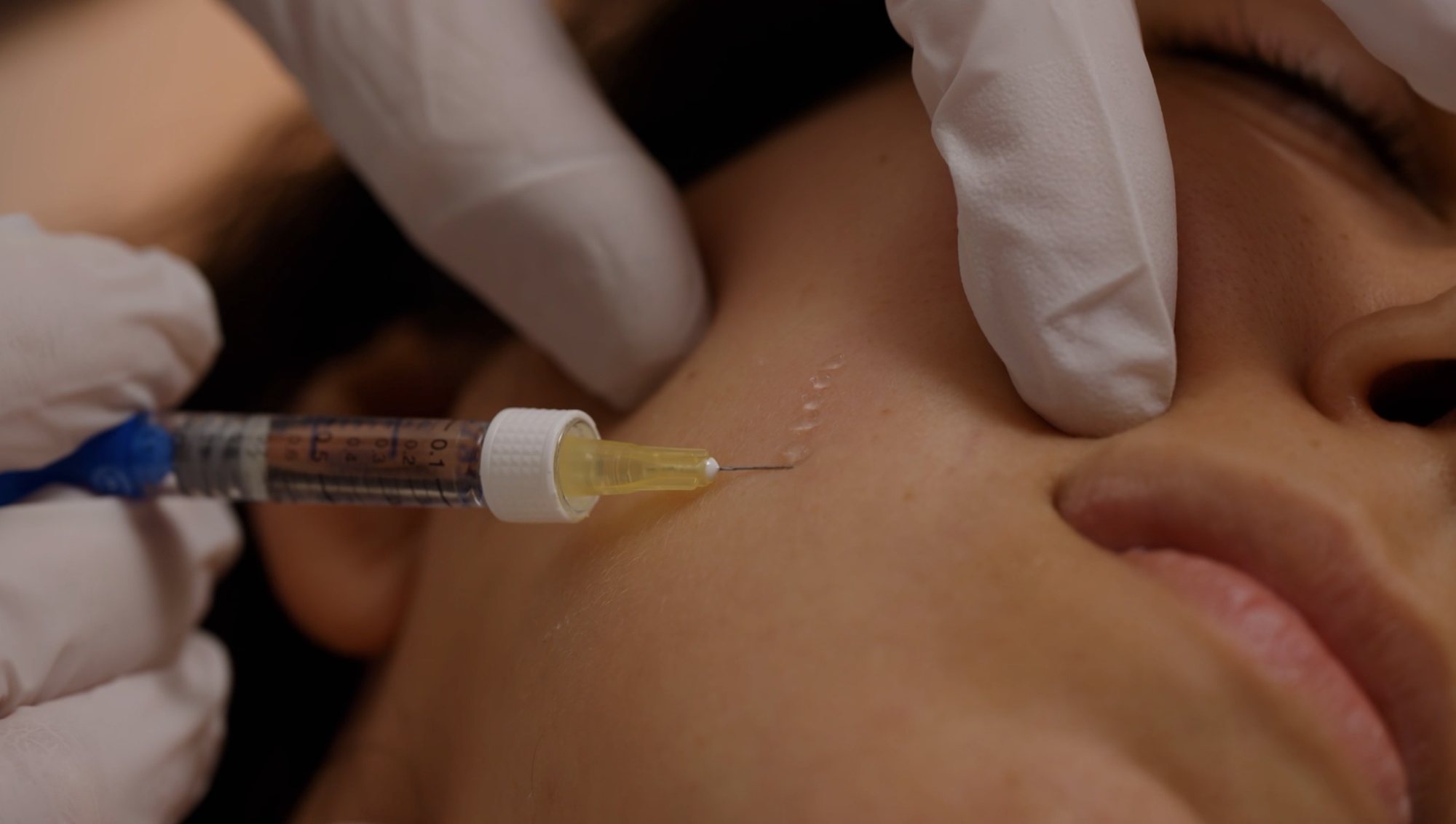 A row of microdroplets placed along the cheek during the Microdroplet Technique at Hornchurch