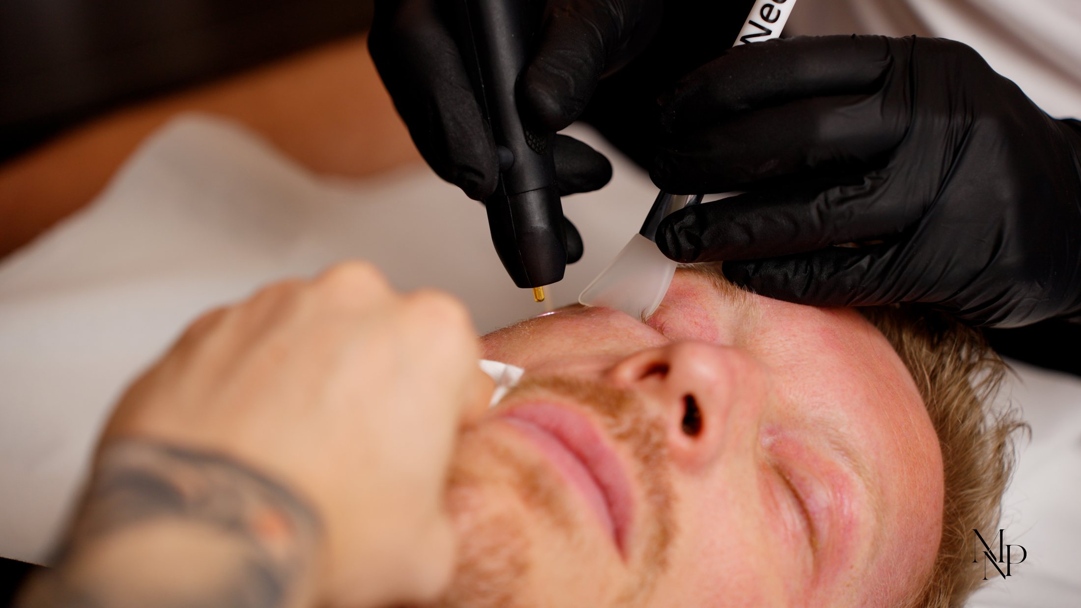 NeoGen EVO applicator at the cheek