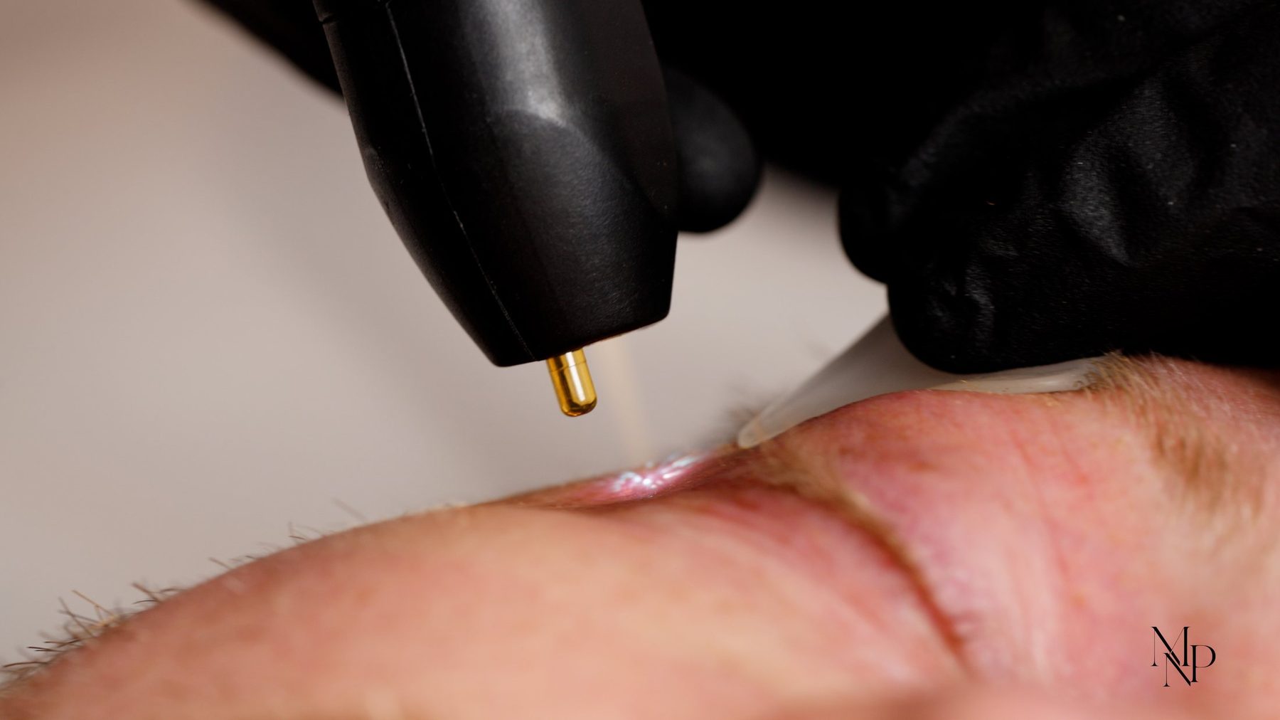 Nitrogen plasma pulse delivered to the skin surface
