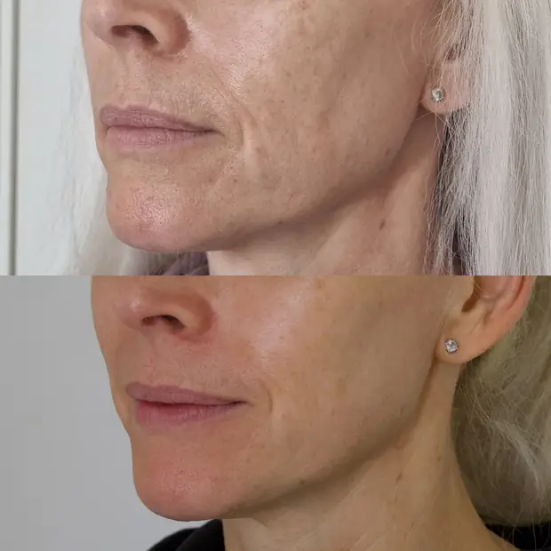 Sophie — jawline and mouth, before above and four weeks below