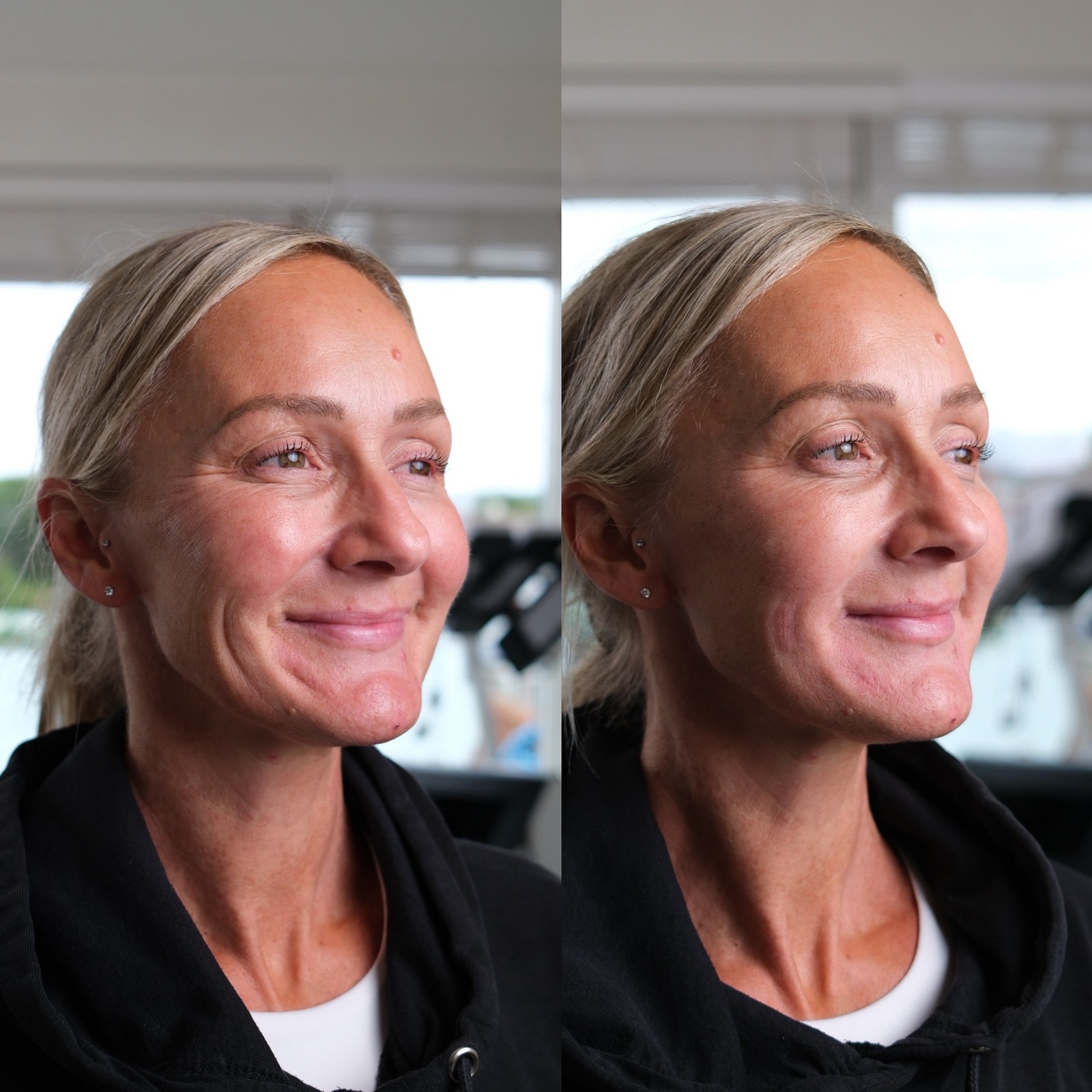 Before and after the microdroplet technique, three-quarter view — lower-face lines softened and balanced