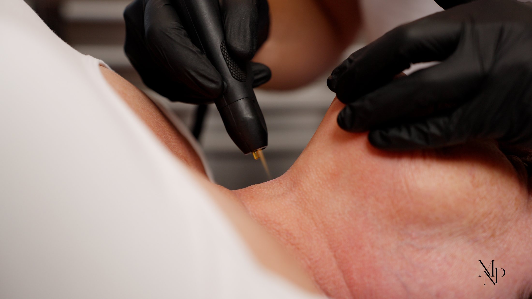 NeoGen EVO treatment along the neck at MNP Clinic Hornchurch