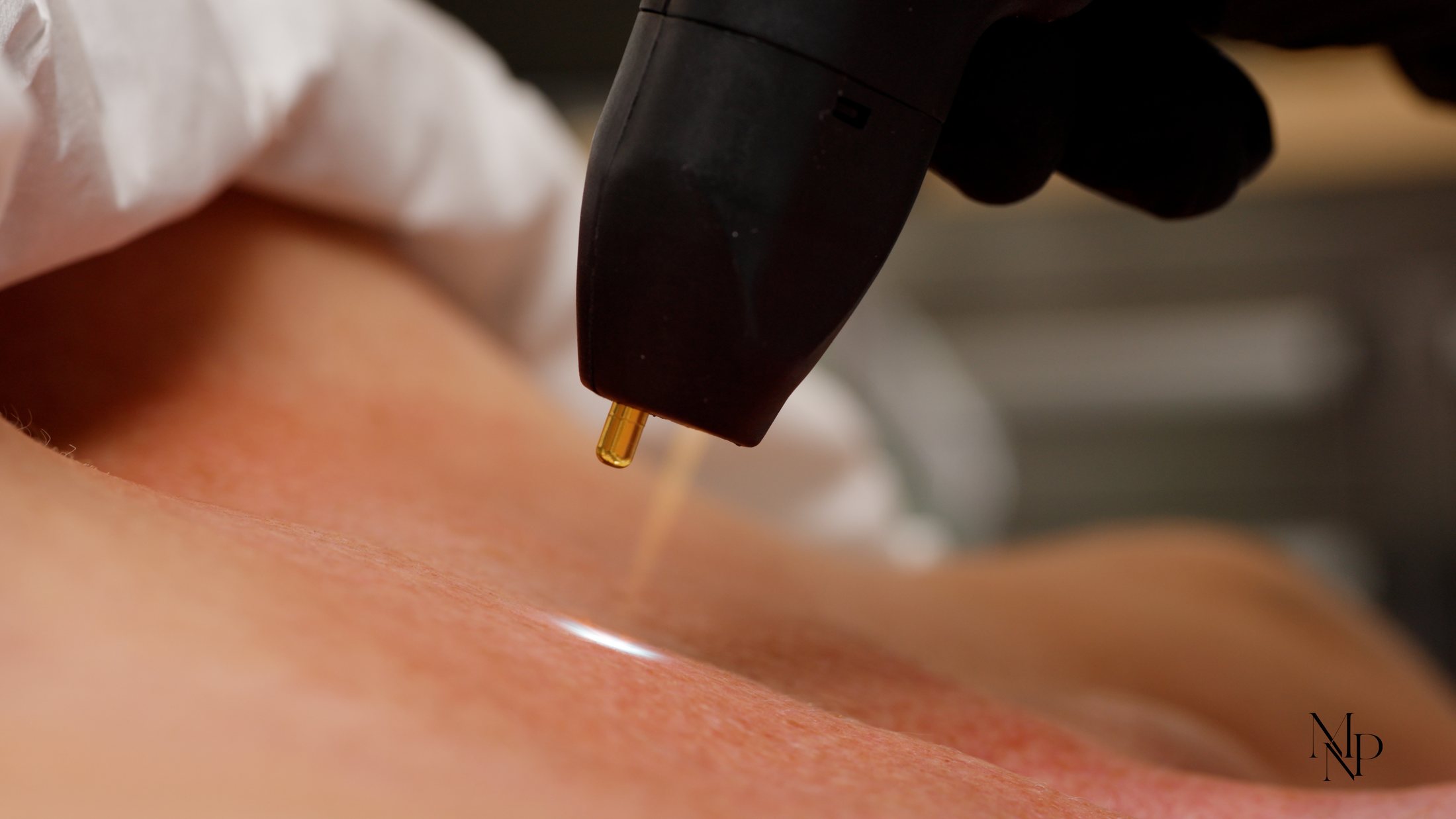 NeoGen plasma energy delivered to the skin at MNP Clinic Hornchurch