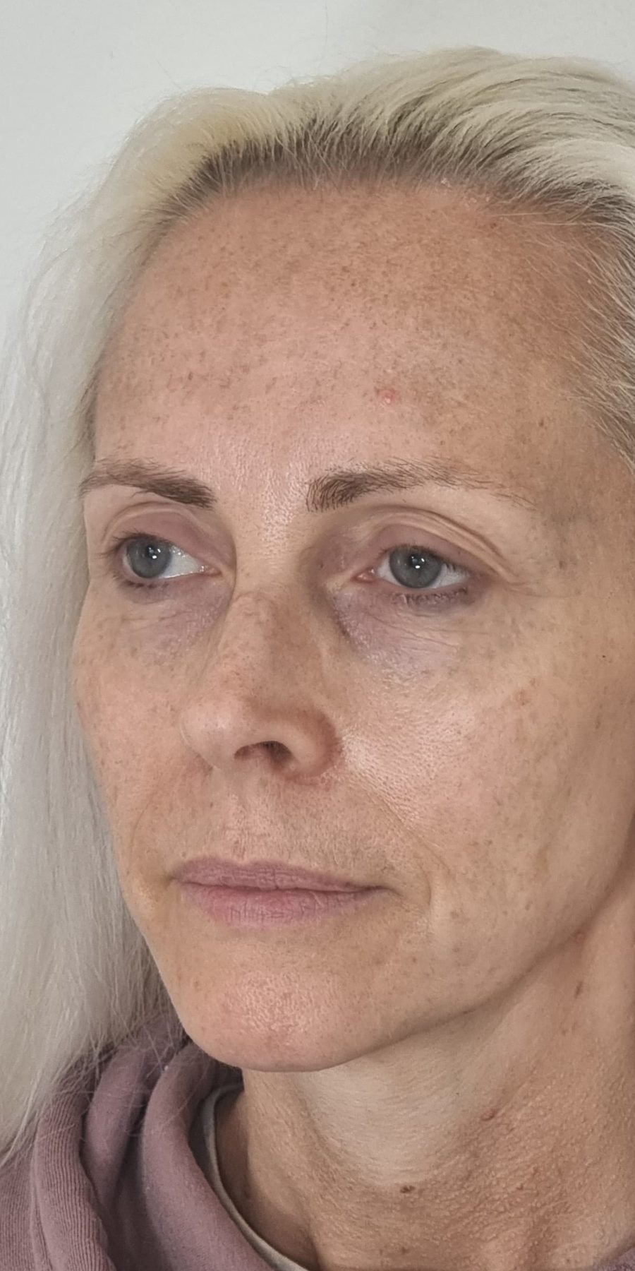 Sophie — before treatment