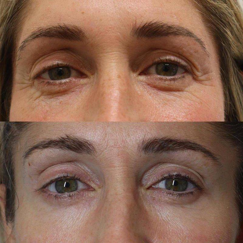 Periorbital — before plasma treatment
