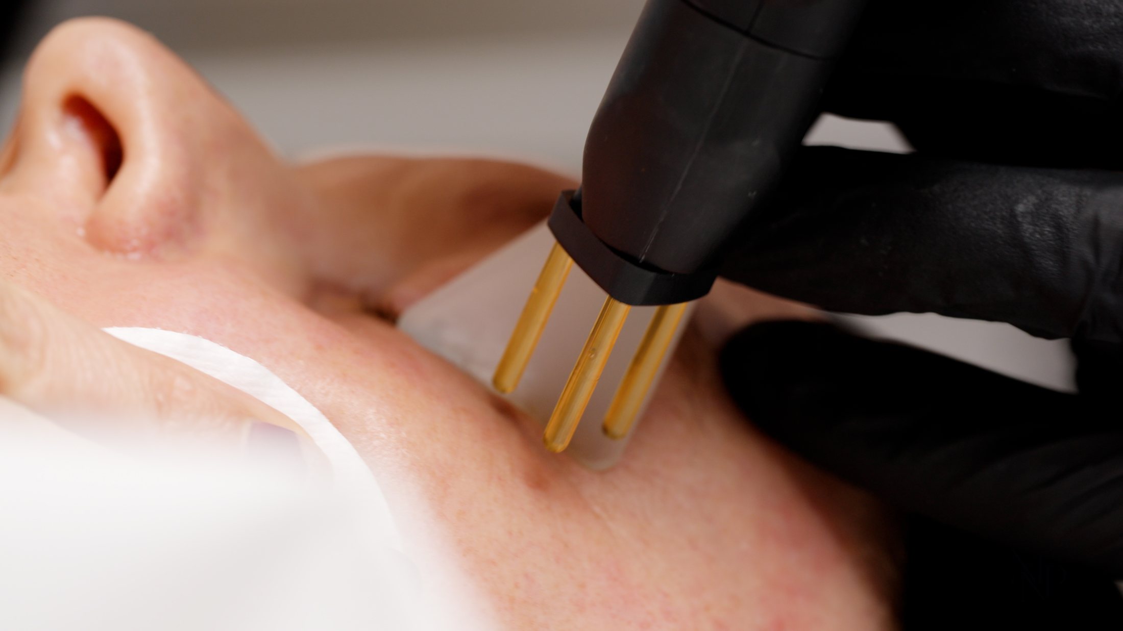 NeoGen EVO treatment in clinic at MNP Clinic Hornchurch