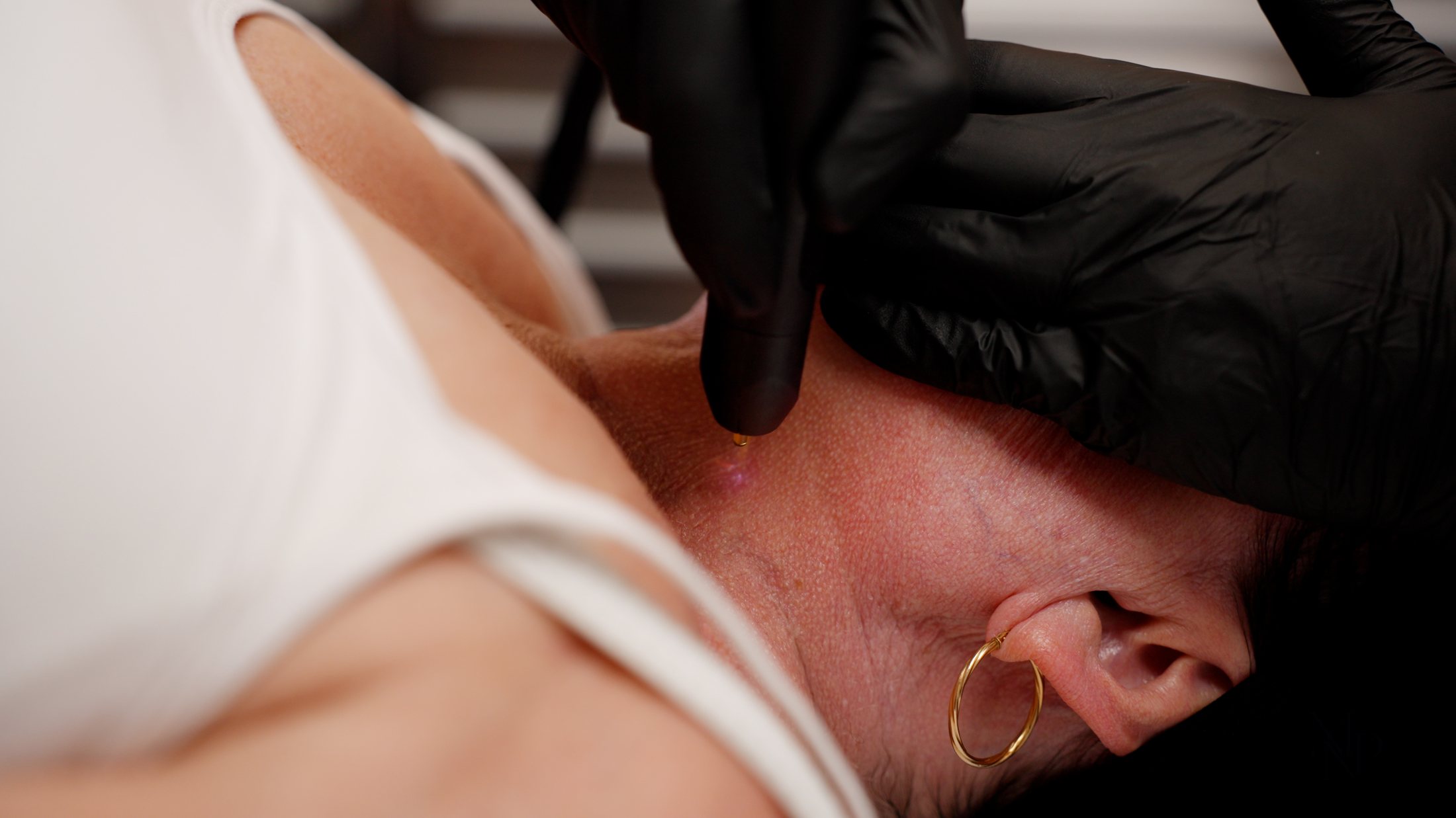NeoGen EVO treatment along the neck