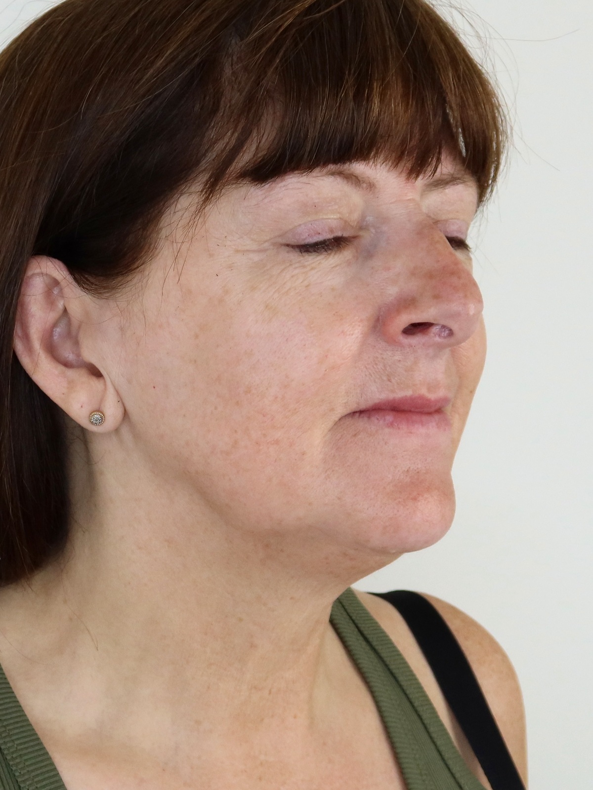 Michelle &middot; three‑quarter &mdash; jawline & lower face — after