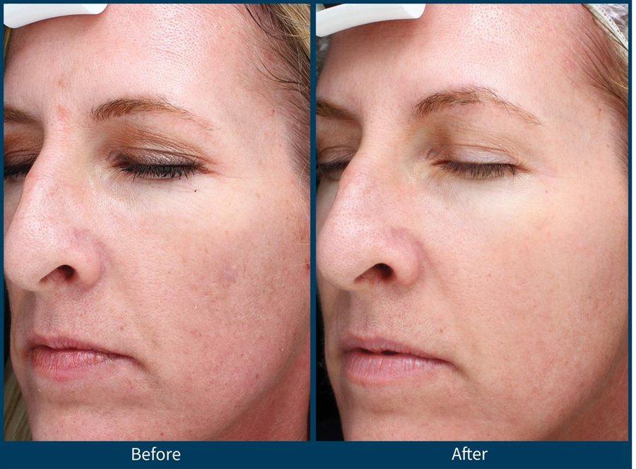 SkinPen — acne scarring 3 treatments