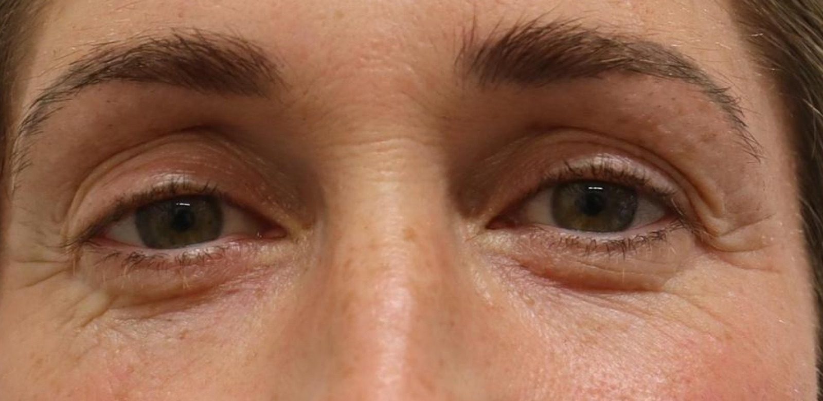 Periorbital — before NeoGen