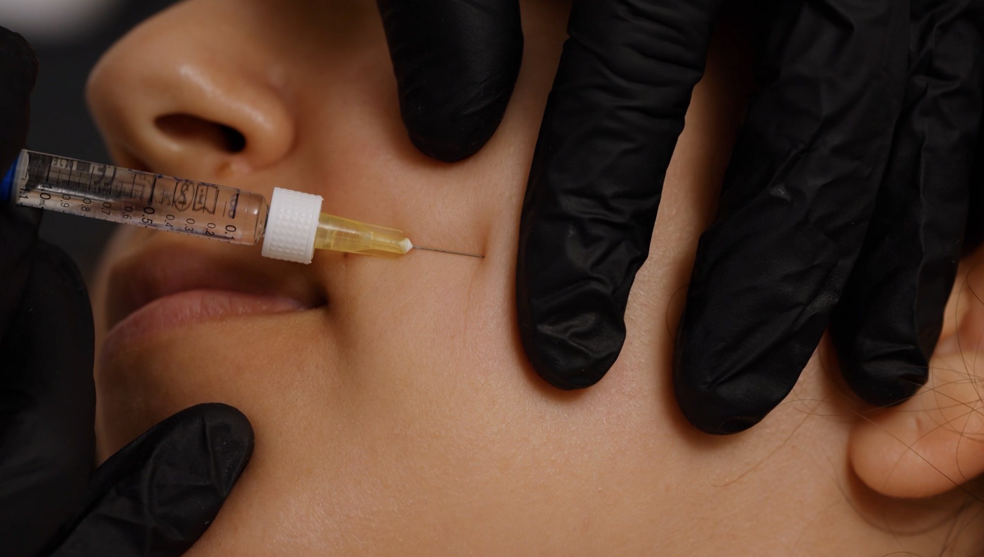 Fine-needle placement during the Microdroplet Technique