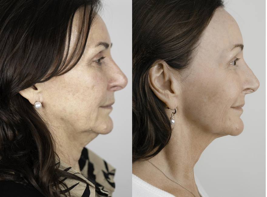 Shirley Ballas — NeoGen plasma before and after, profile