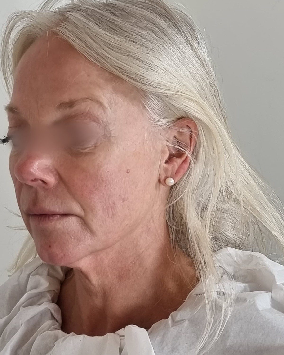 Before Collagen Wave — three-quarter view