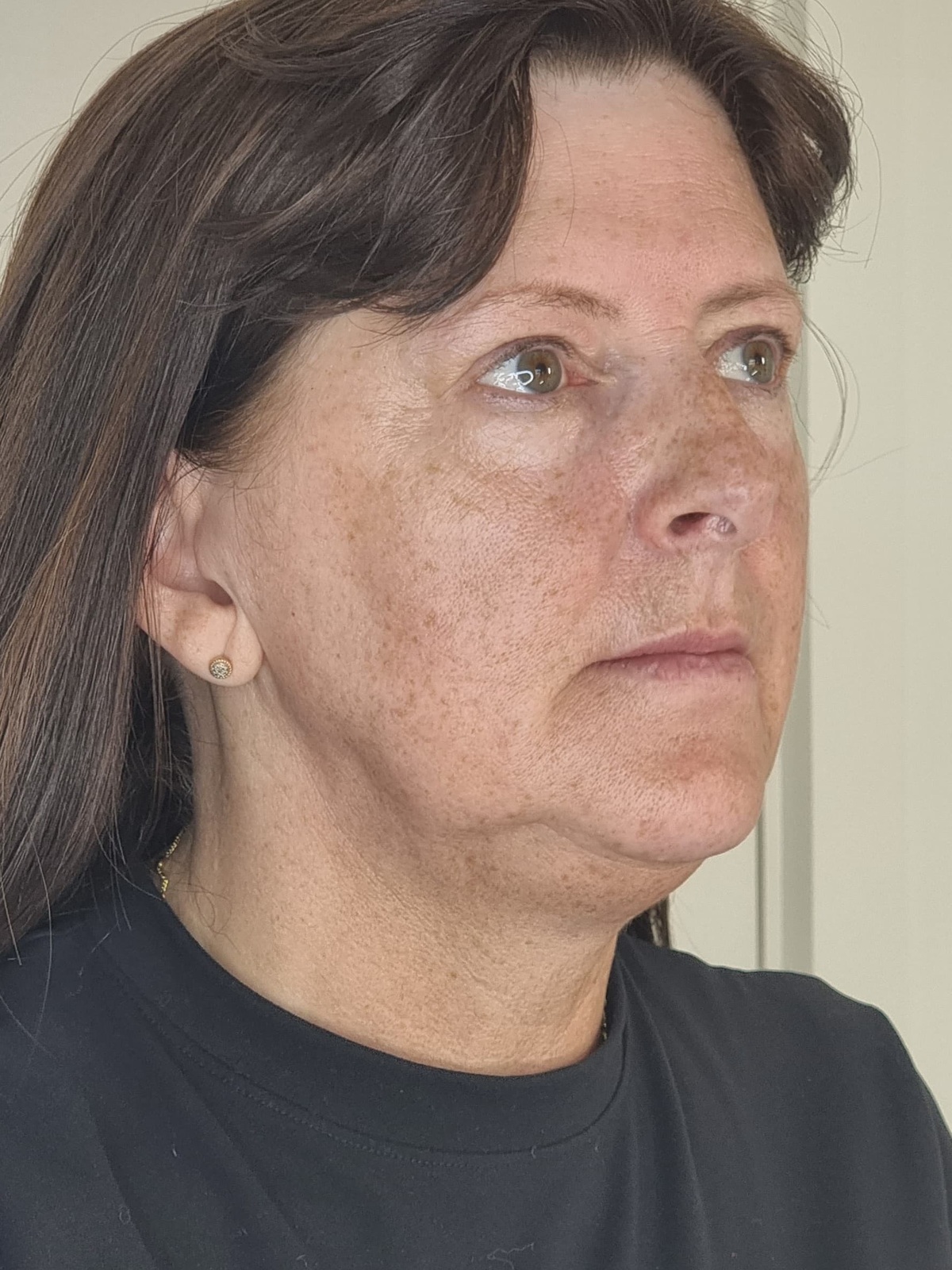 Michelle &middot; three‑quarter &mdash; jawline & lower face — before