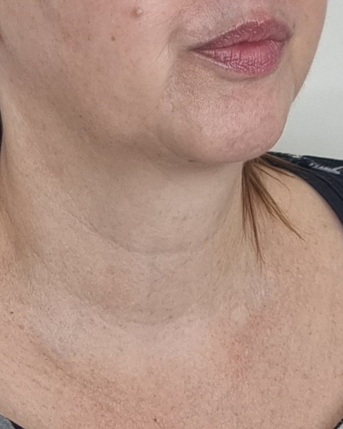 Sophie &middot; jawline & neck — after