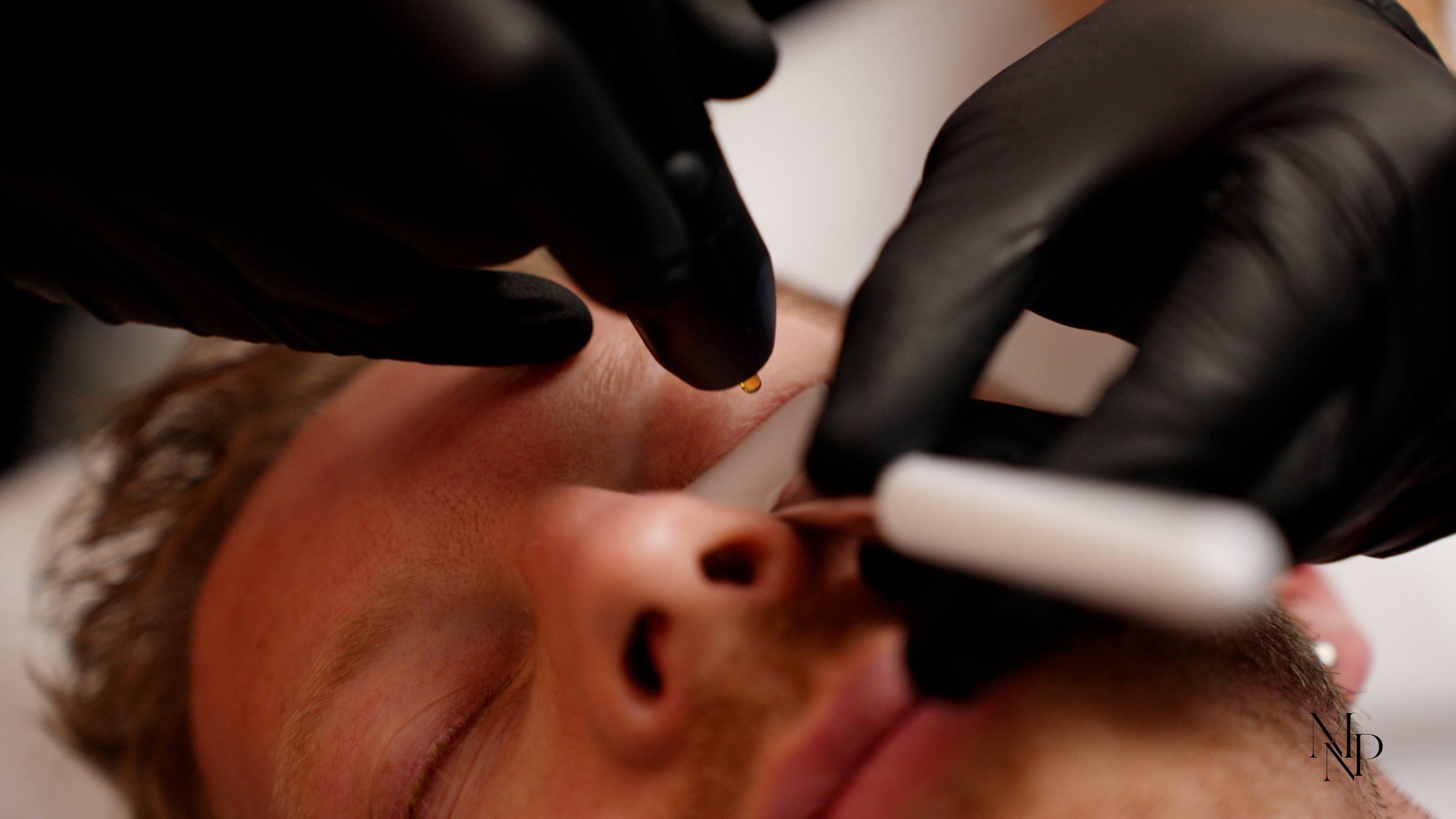 NeoGen EVO treatment around the eye area