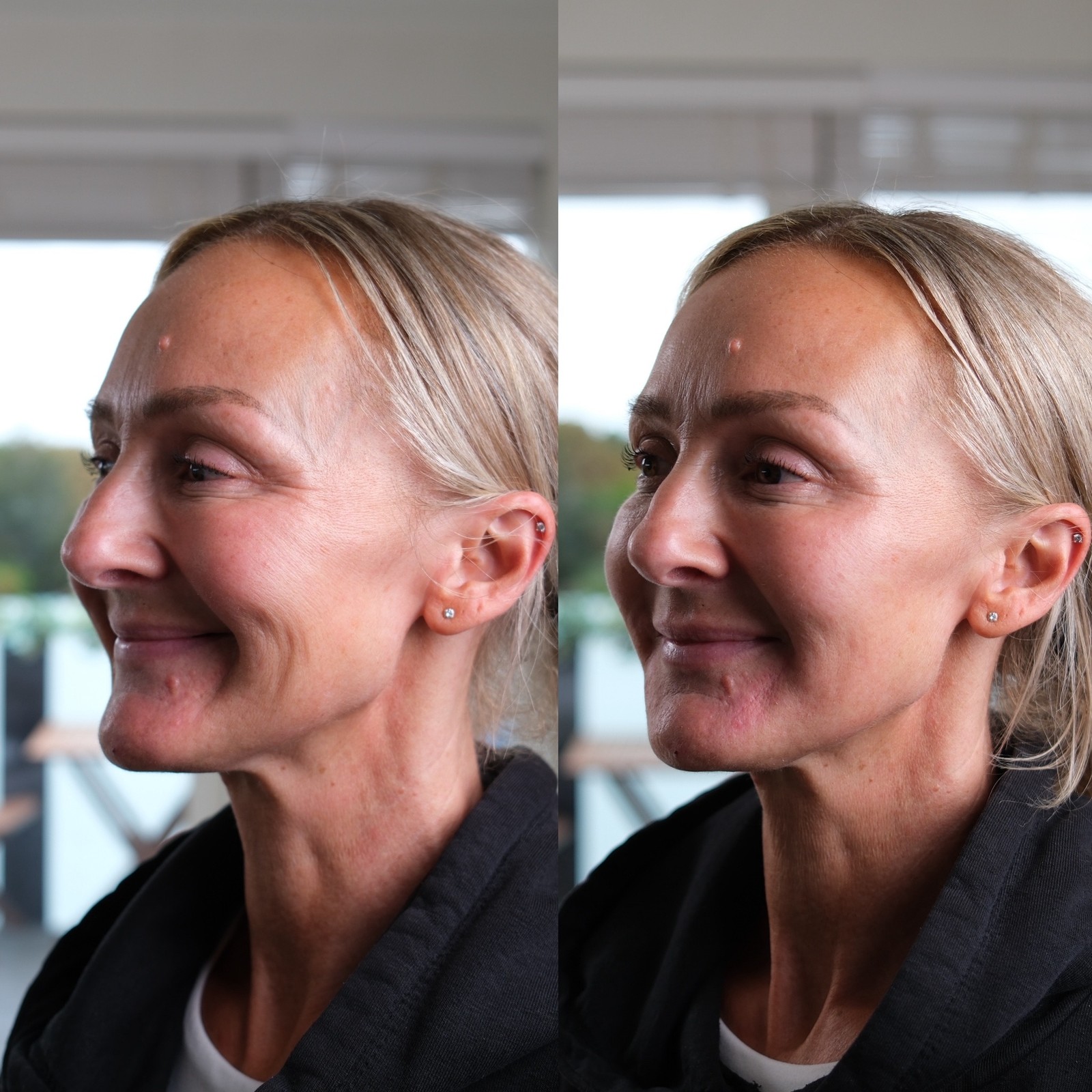 Before and after the microdroplet technique, profile view — jawline and mouth-line skin visibly smoother