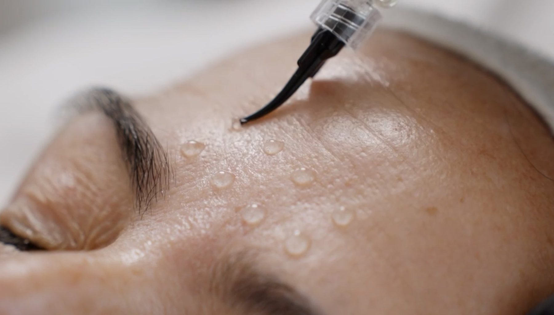 Polynucleotide solution placed across the skin during treatment at MNP Clinic Hornchurch