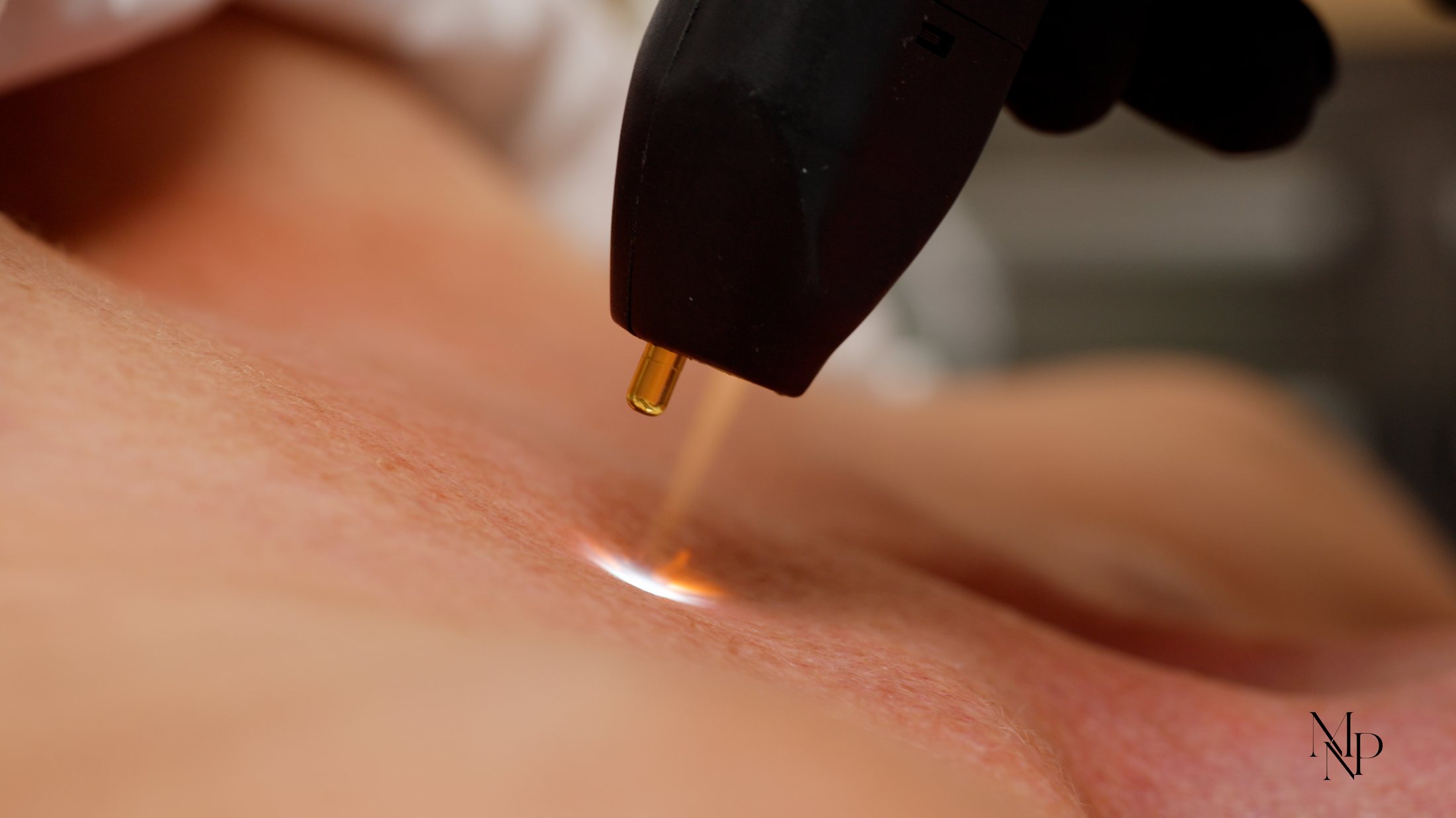 Nitrogen plasma energy meeting the skin during NeoGen EVO treatment