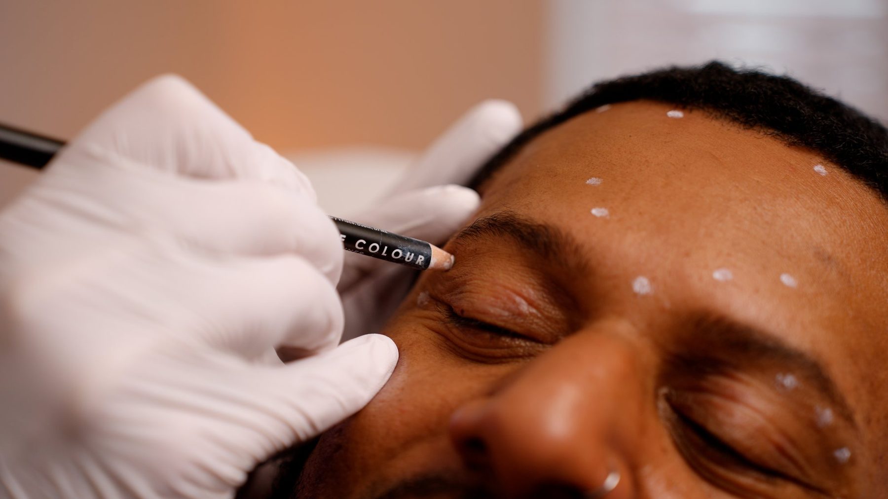 Mapping the treatment area before wrinkle-relaxing treatment at MNP Clinic Hornchurch