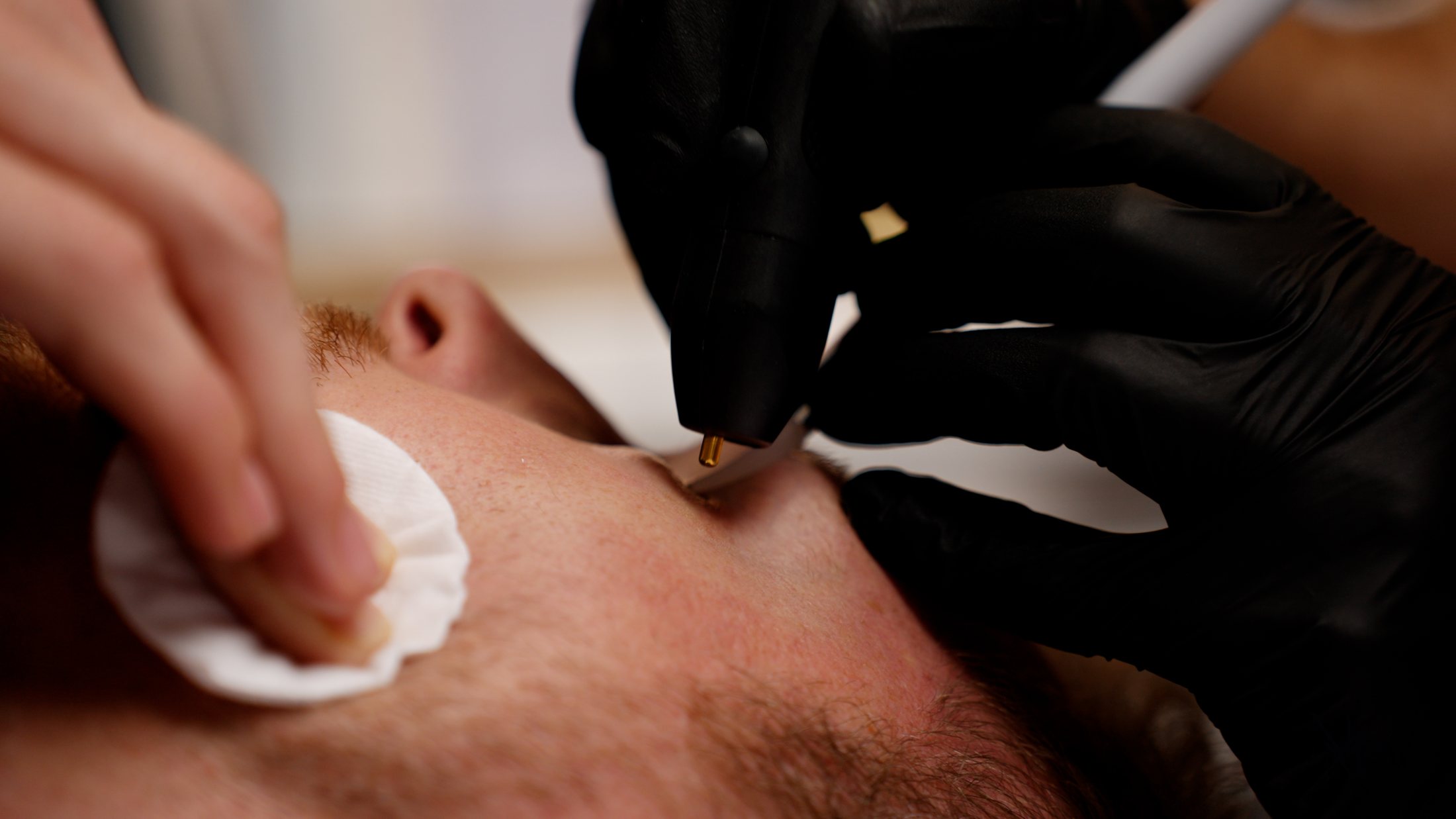 NeoGen EVO treatment along the jawline