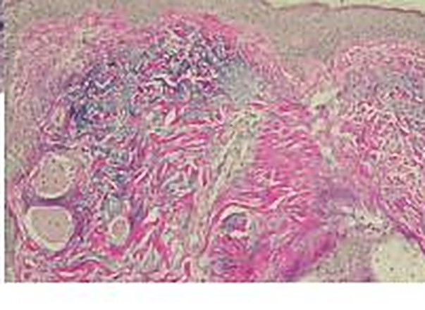 Biopsy one year after NeoGen — continued new collagen, healthier junction