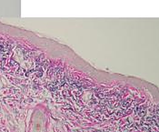Biopsy three months after NeoGen — elastosis reduced, collagen band widening