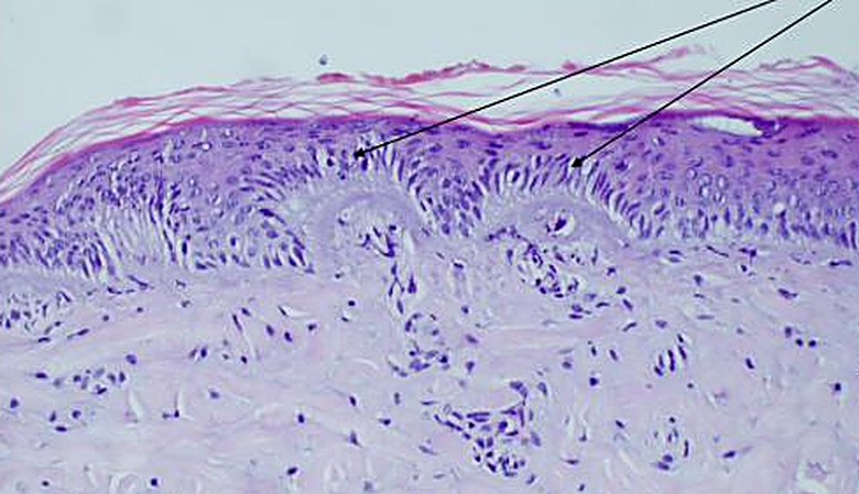 Biopsy on the day of a 3.5J NeoGen treatment — skin architecture fully intact