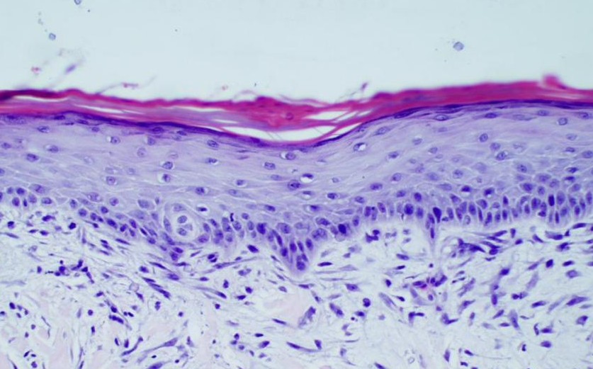 Biopsy ten days after NeoGen — fully regenerated epidermis with intense fibroblast activity beneath