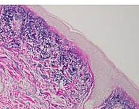 Biopsy before treatment — sun damage with a narrow collagen band